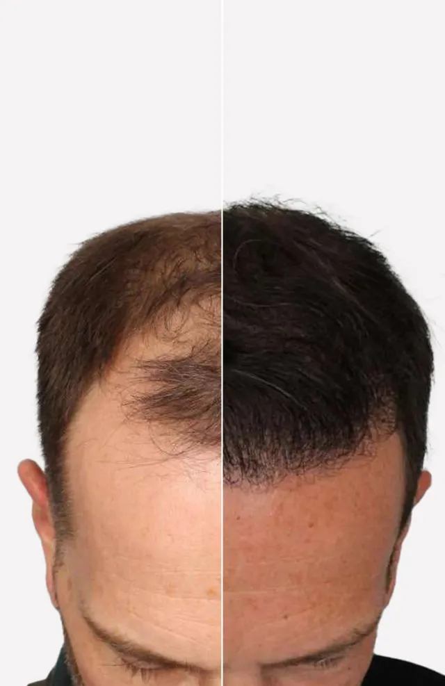 FUE haartransplantatie resultaat - back view